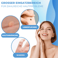Warzen & Leberflecken Entferner Set eBay - Waagemann