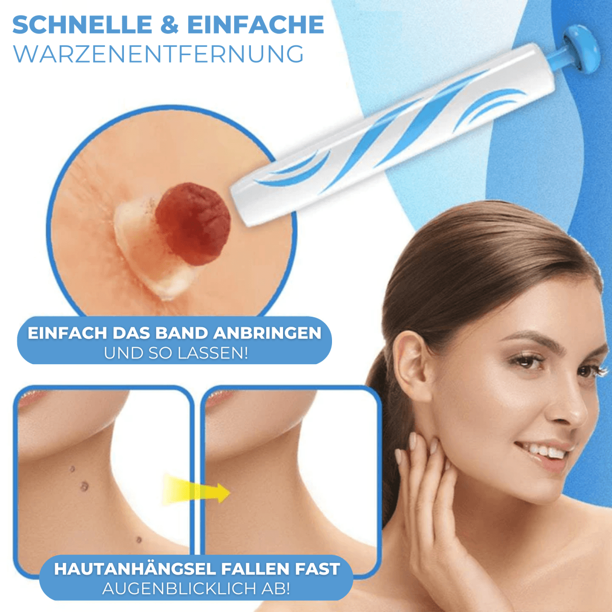 Warzen & Stielwarzen Entferner Set - Waagemann