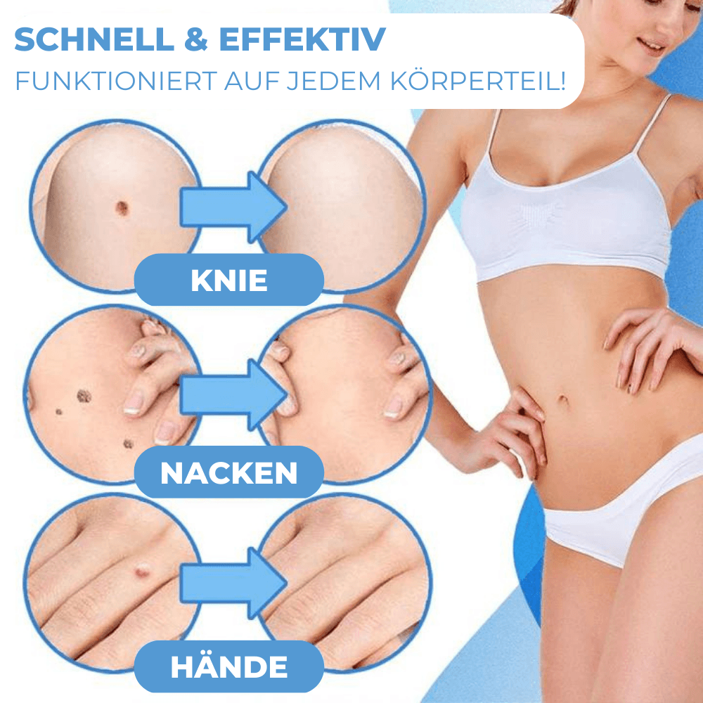Warzen & Stielwarzen Entferner Set - Waagemann