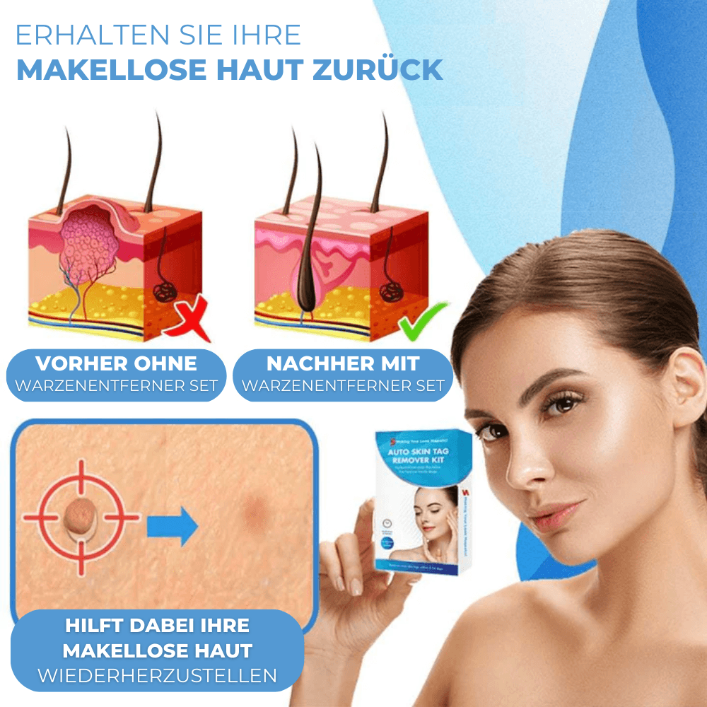 Warzen & Stielwarzen Entferner Set - Waagemann