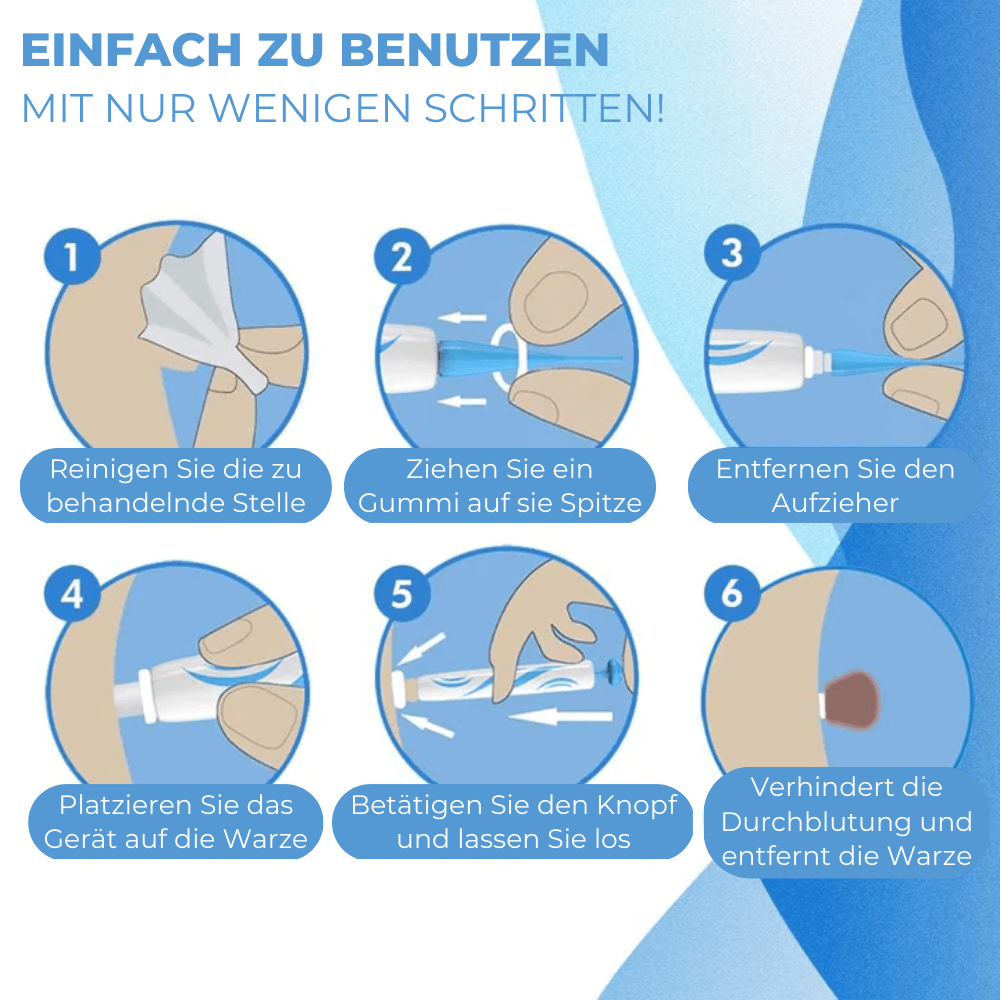 Warzen & Stielwarzen Entferner Set - Waagemann