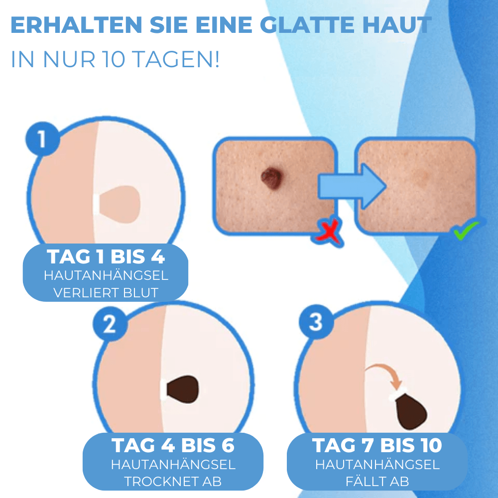 Warzen & Stielwarzen Entferner Set - Waagemann